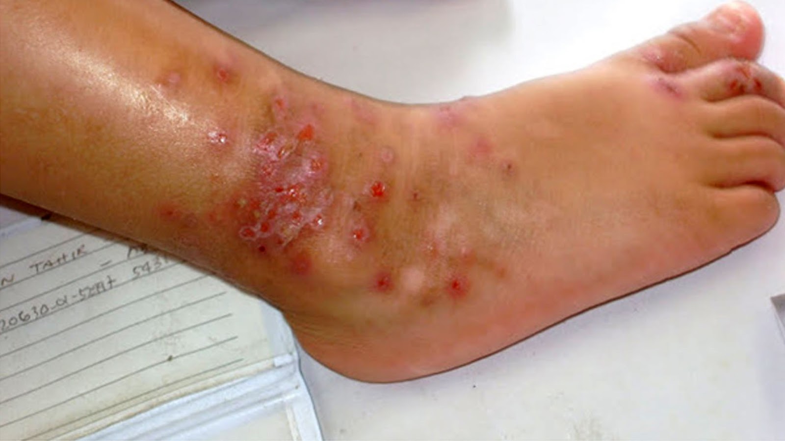 Cara Mengobati Gatal Gatal Timbul Bernanah Pada Tangan Dan Kaki