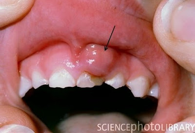 viêm chân răng có mủ-1