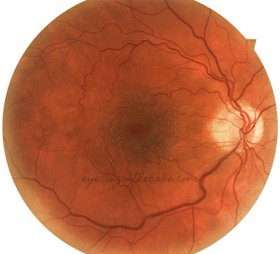 Retinal Photo Of An ERM Note The Gold Shimmery Appearance Retina In Center Image With A Pseudohole Darker Red Circle Middle Retinal Photo Of An ERM Note The Gold Shimmery Appearance Retina In Center Image With A Pseudohole Darker Red Circle Middle