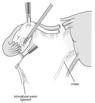 infundibular ligament