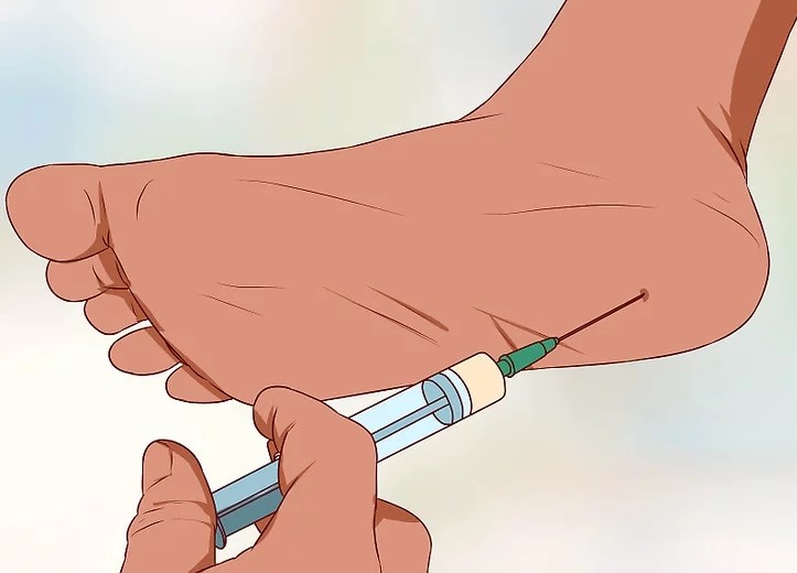 Triathlon Tips Cortisone Shot for Runners with Plantar Fasciitis Heel Pain