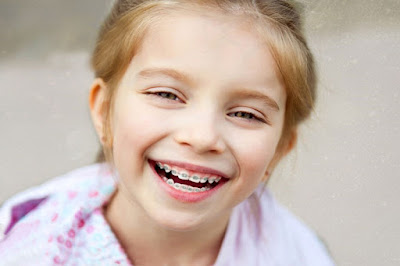 Niềng răng cho trẻ em ở độ tuổi nào là hiệu quả? 2