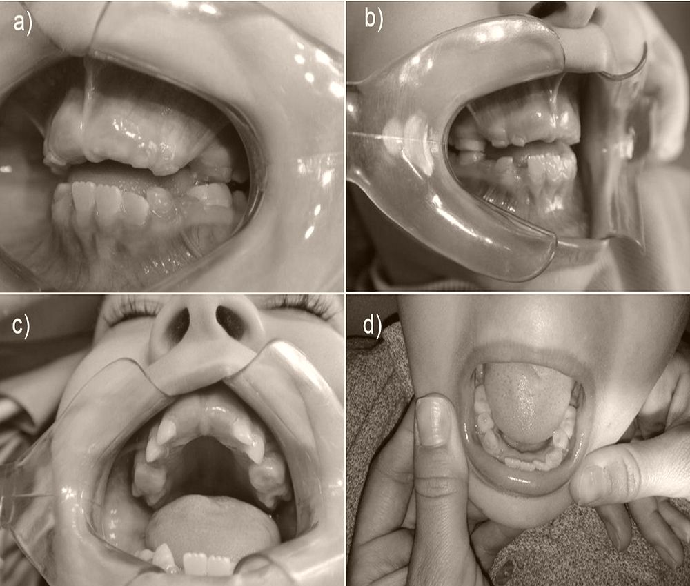 ORAL REHABILITATION of a child with dentinogenesis imperfecta OdontoVida