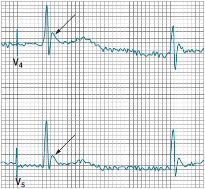electrocardiograms