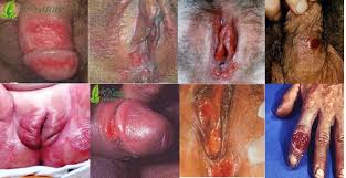 penyebab luka sipilis pada penis penyebab luka sipilis pada penis
