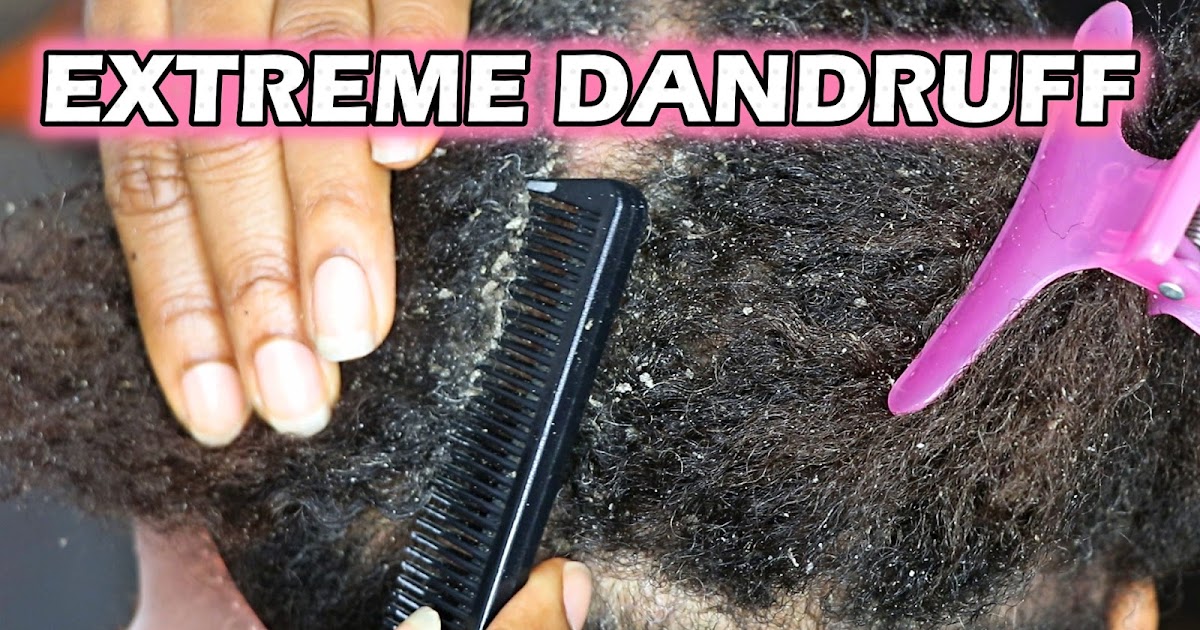 EXTREME DANDRUFF REMOVAL Huge Flakes Psoriasis Close Up Natural