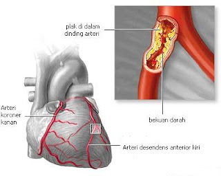Penyakit Jantung Koroner (Coronary Artery Disease) atau Penyakit  Jantung Iskemik