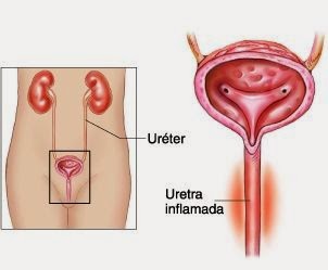 medicamentos homeopaticos para uretritis