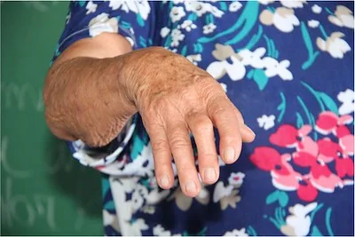 Download Makalah Konsep Askep Rheumatoid Arthritis Pada Lansia