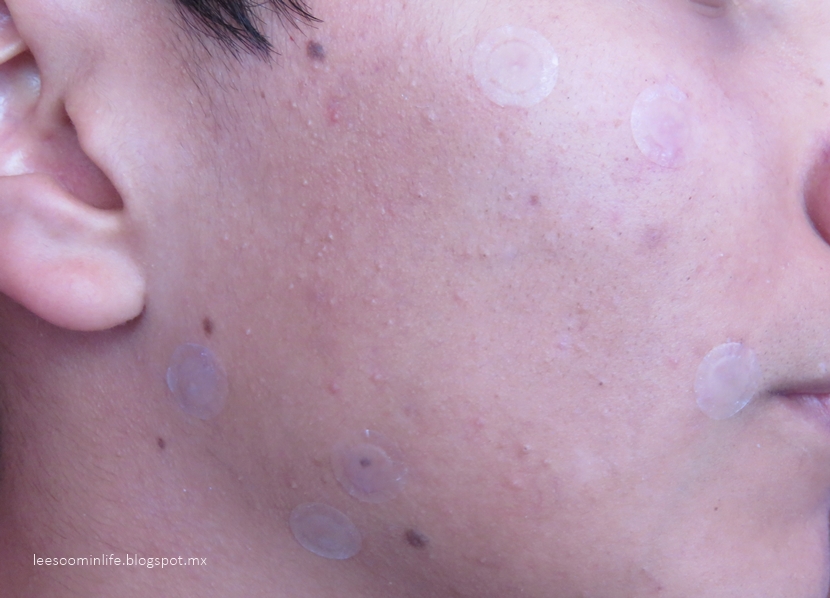 [JOLSE] TIA'M Spot Remover Kit review My Wonderland