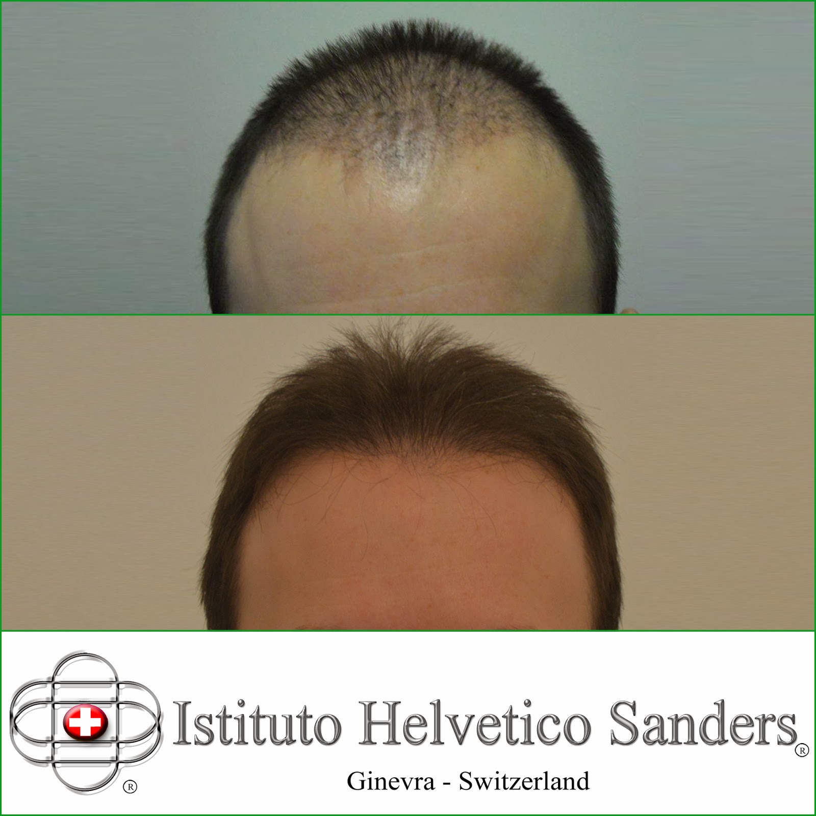 Trapianto Capelli Risultati