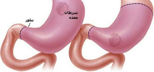 أسباب الإصابة بسرطان المعدة أسباب الإصابة بسرطان المعدة