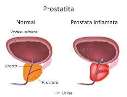 prostatita ascendenta