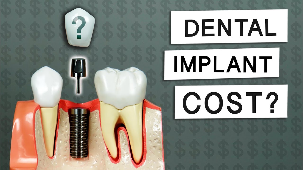 Affordable Dental Implant treatments in Bangalore - Sri Aakrithis Dental  Lounge And Maxillofacial Center