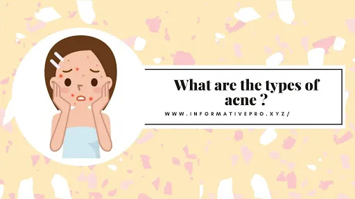 what are the types of acne ?