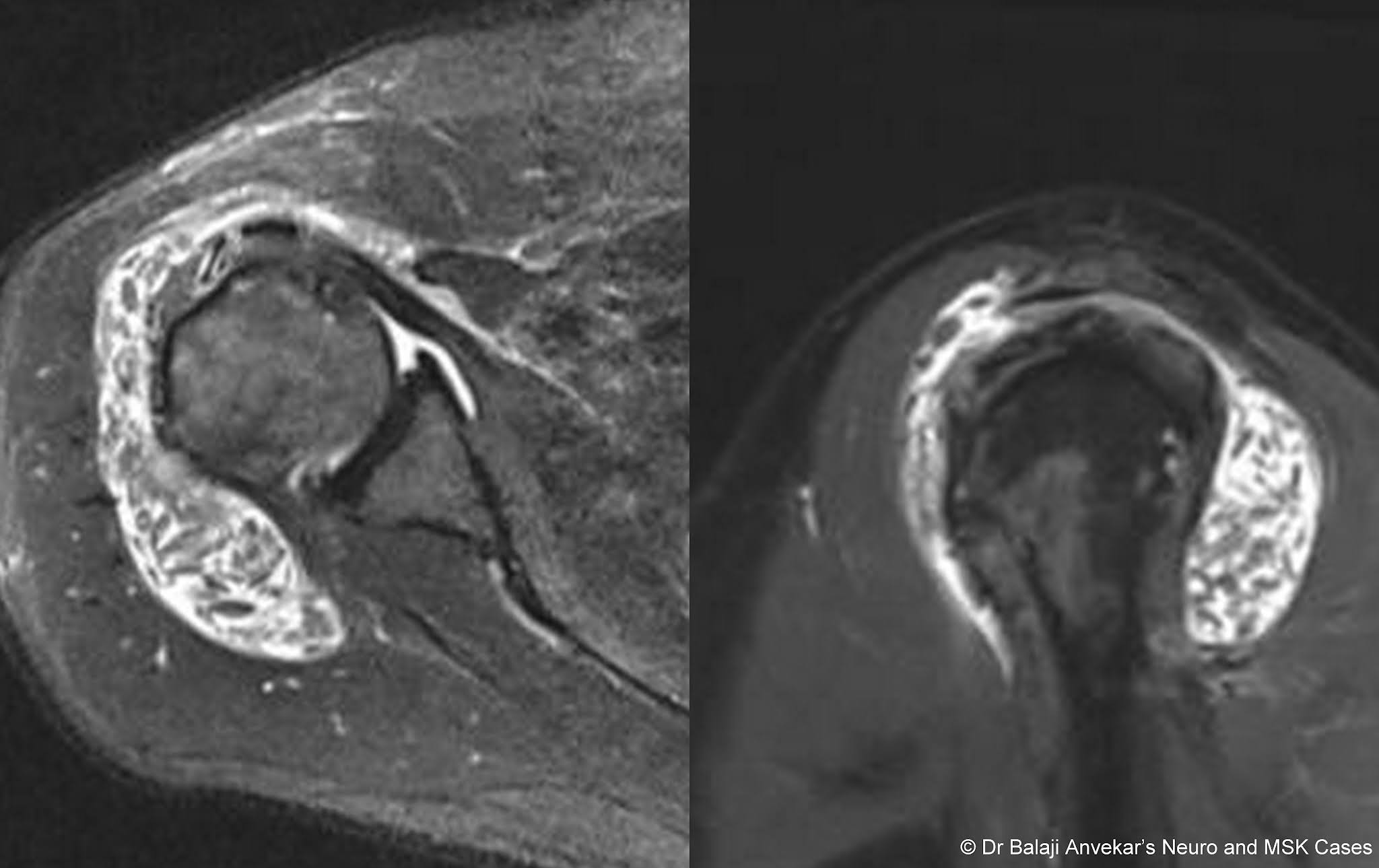 Dr Balaji Anvekar FRCR Rice bodies in subdeltoid bursa MRI