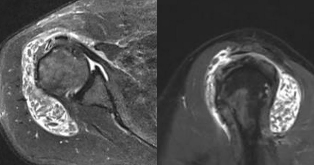 Dr Balaji Anvekar FRCR Rice bodies in subdeltoid bursa MRI