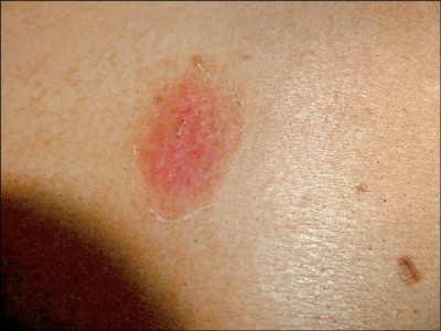 清明節掃墓先做好保護 避免恙蟲叮咬感染