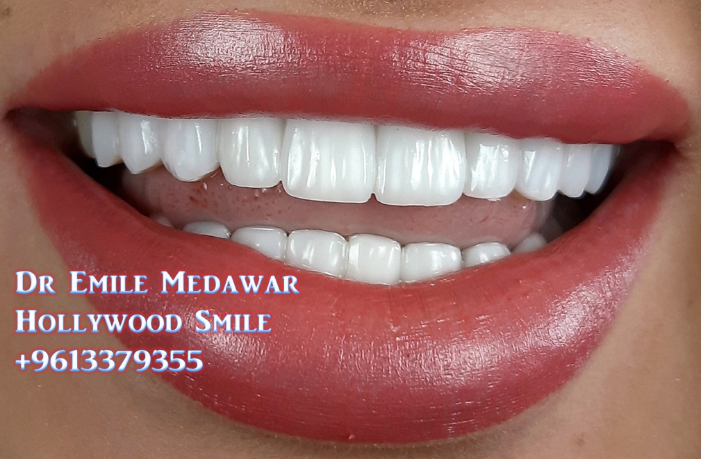 Dr Emile Medawar Smile Porcelain Veneers, Direct Composite Veneers