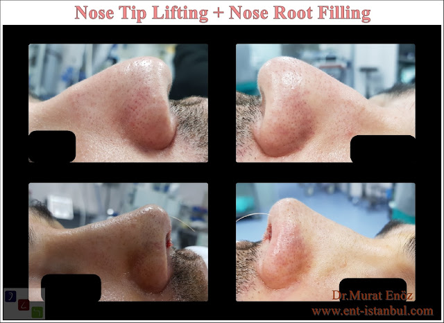 Nose tip lifing in Istanbul,Nose root filling with underskin tissue,Rhinoplasty without breaking the bone, Nose tip plasty in men, Natural nose aesthetic surgery for male