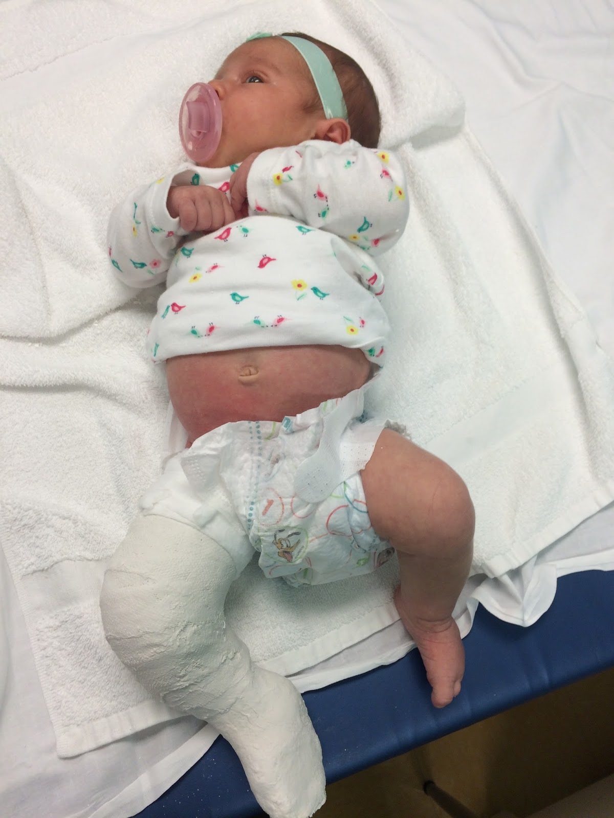 Clubfoot Baby / Ponseti baby in casts (photo by Amanda Price) clubfoot