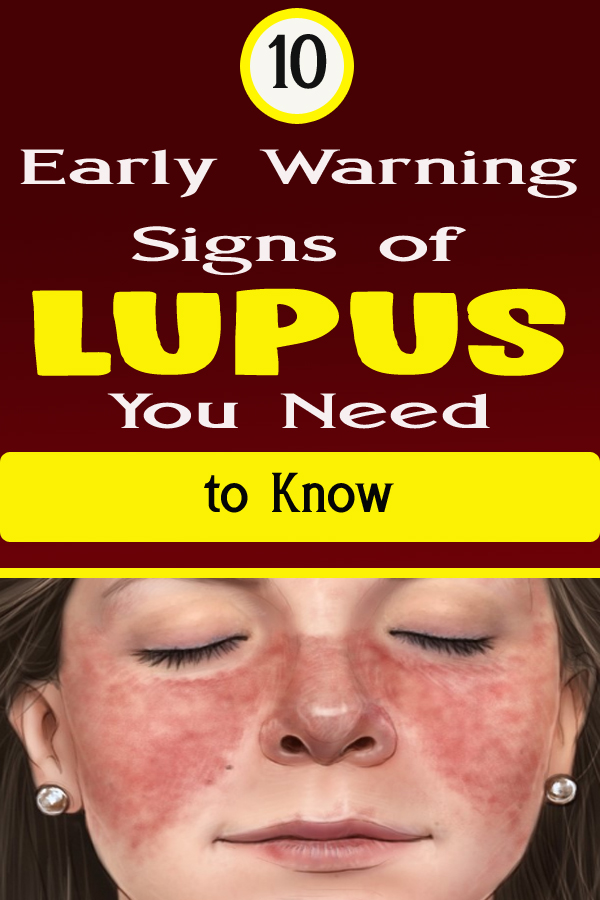 10 Early Warning Signs Of Lupus You Need To Know