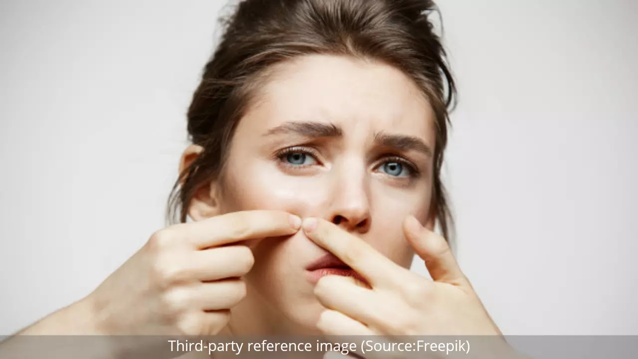 Home Remedies for Acne | HealthInsta Home Remedies for Acne | HealthInsta