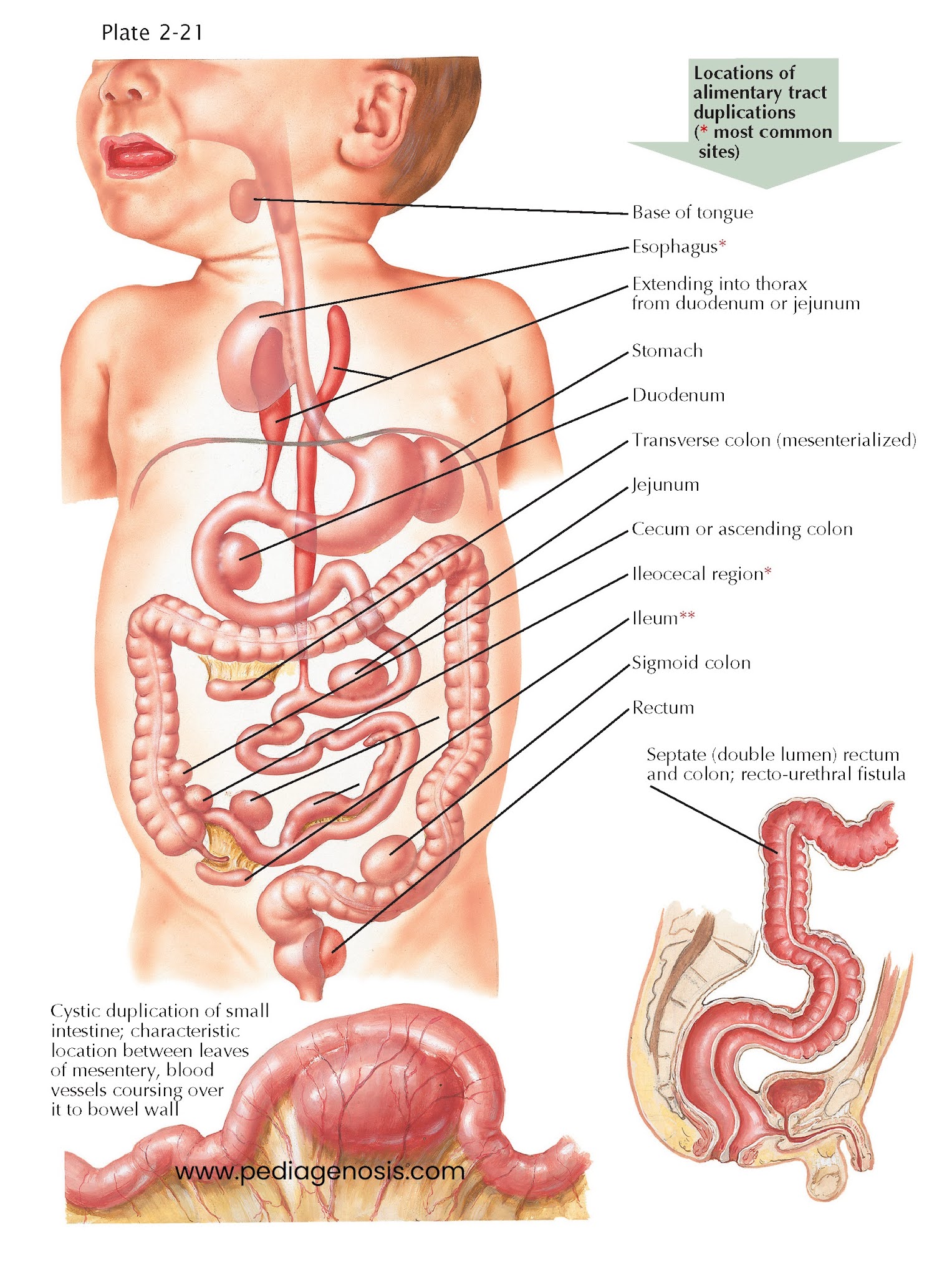 Duplications of Alimentary Tract