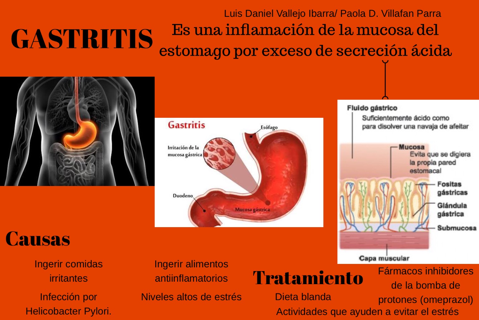 DIVULGACIÓN CIENTÍFICA UG Gastritis