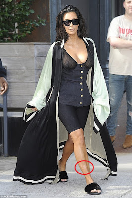 1a3 Kim Kardashian shares unfiltered photos of her psoriasis patches
