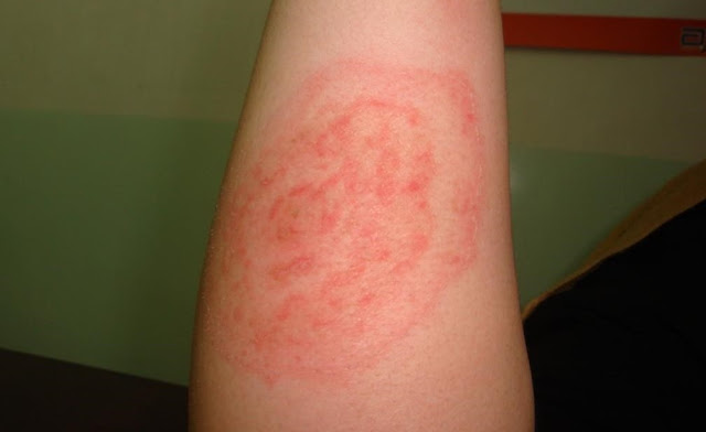 Tinea imbricata Nedir? Belirtileri, Nedenleri, Tanısı ve Tedavisi