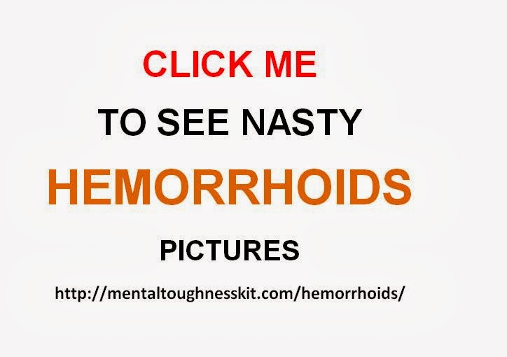 The Ultra Vault External Hemorrhoids