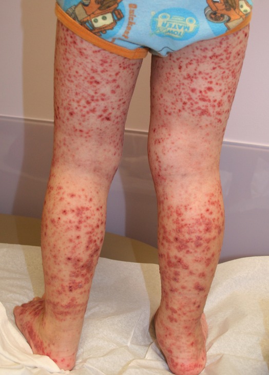 Trombose no pé icd 10