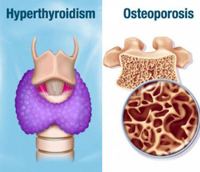 Osteoporosis dan hipertiroidisme