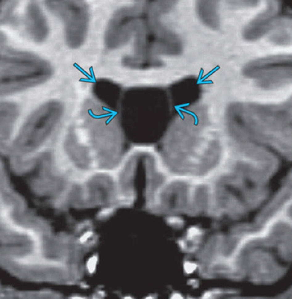 Cavum Septi Pellucidi (CSP) Brain imaging