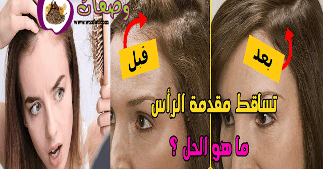 علاج تساقط الشعر الشديد عند النساء