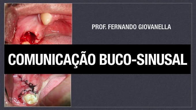 CIRURGIA ORAL: Comunicação Buco-sinusal - Prof. Fernando Giovanella