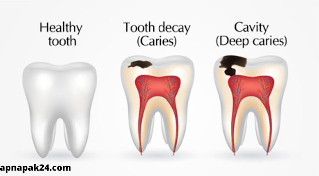 How Do  Cavities Look Like?