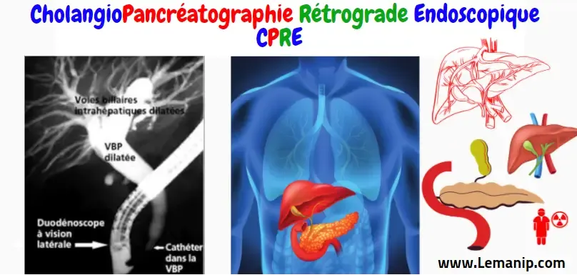 CholangioPancréatographie Rétrograde Endoscopique CPRE