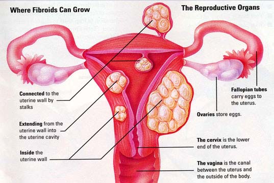 Fibroids | Nurselk.com