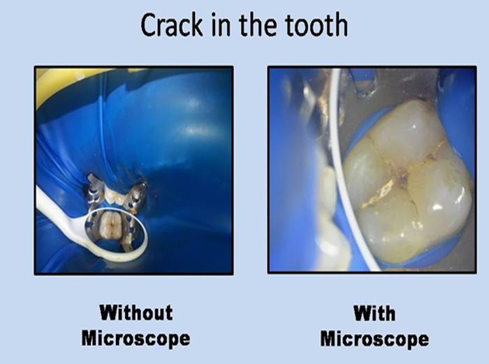 What is microscopic dentistry and its benefits