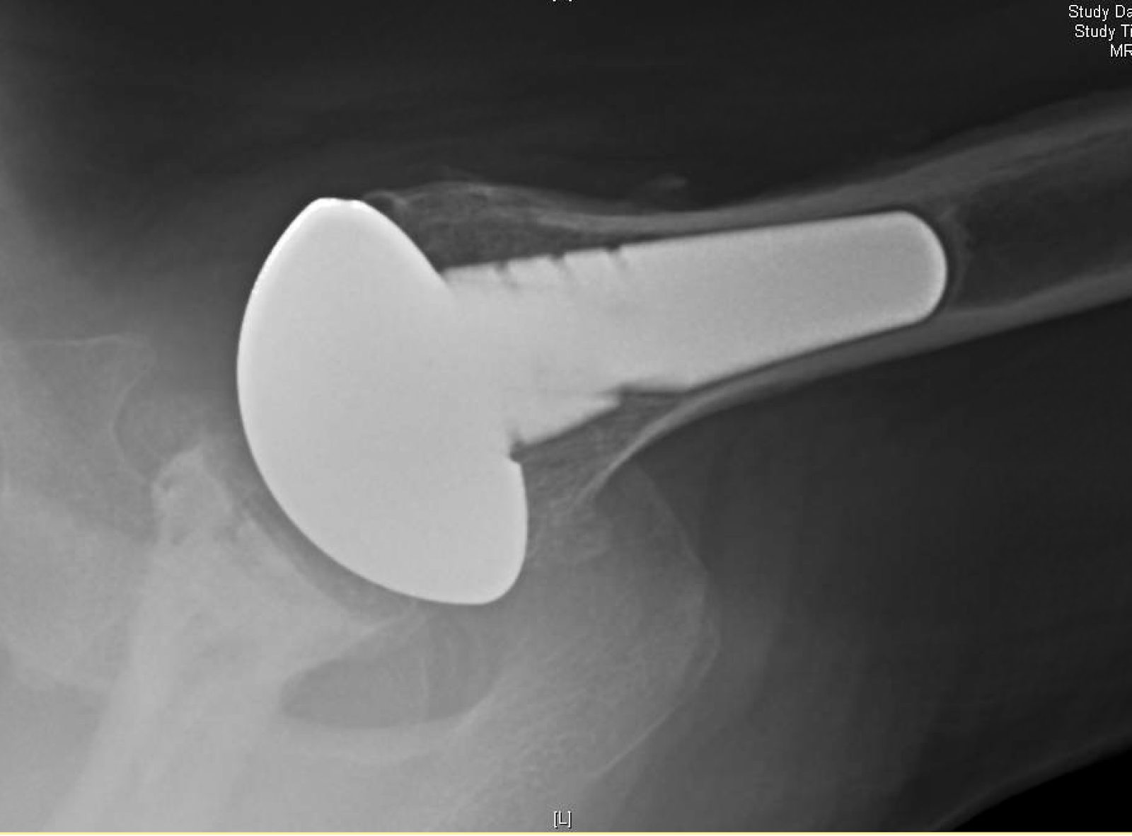 Shoulder Arthritis / Rotator Cuff Tears / Shoulder Pain Total