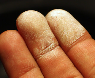 35%'luk çözeltisinin cilde dokunduktan sonra etkisi [H2O2]
