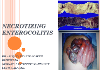 necrotizing enterocolitis