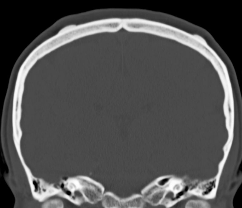 My E Radiology Cases Case 478 40 Year Old Woman With Lumps At The Scalp