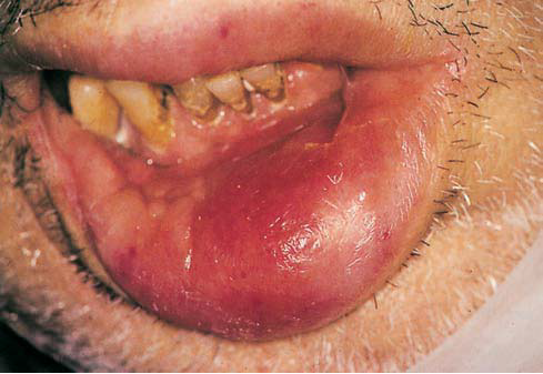 Mouth Sores and Lip Conditions: Conditions, Treatments ...