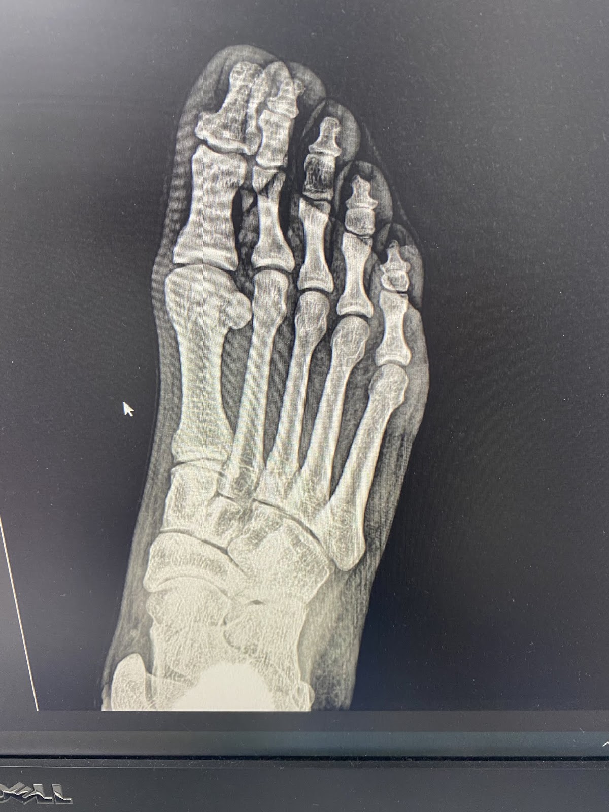 Foot and Ankle Problems By Dr. Richard Blake Sesamoid Fracture Email
