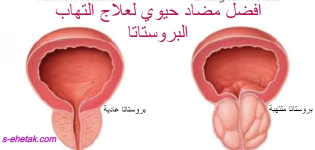 افضل مضاد حيوي لعلاج التهاب البروستاتا