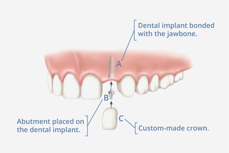 Best Dental Implants Manufacturer Pivot Implants What are dental