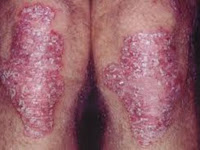 Cara Mengobati Penyakit Gatal Eksim Atau Dermatitis